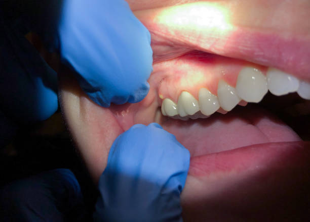 Best Emergency Care for Gum Disease in Salamanca, NY